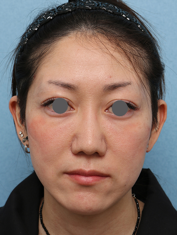 症例写真,ウルセラシステムの症例 フェイスラインが引き締まり小顔になった女性,After（2ヶ月後）,ba_ulthera034_b01.jpg