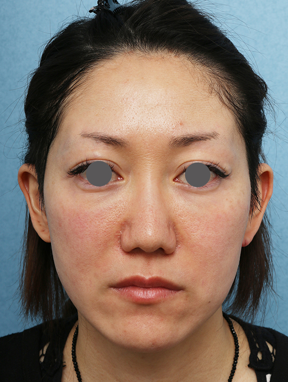 症例写真,ウルセラシステムの症例 フェイスラインが引き締まり小顔になった女性,Before,ba_ulthera034_b01.jpg