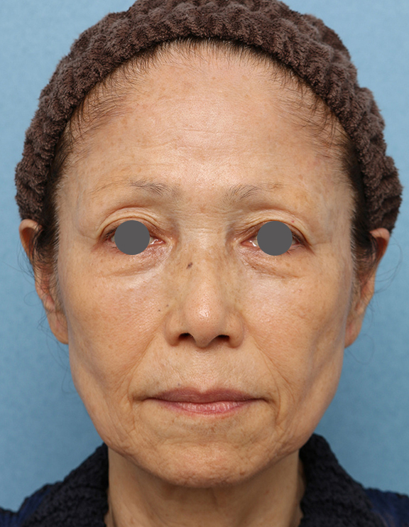 Vシェイプリフト（ヒアルロン酸注射）の症例 顔全体をふっくらさせた女性,After（2ヶ月後）,ba_v_shapelift019_a01.jpg