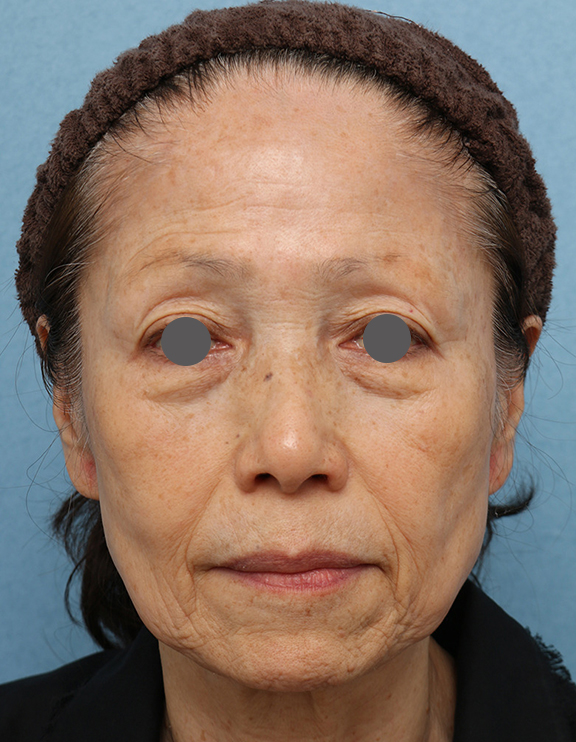 Vシェイプリフト（ヒアルロン酸注射）の症例 顔全体をふっくらさせた女性,Before,ba_v_shapelift019_b01.jpg