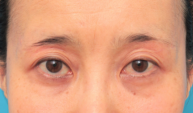 注射式シワ取り 長期持続型ヒアルロン酸注入,目の上の窪みにヒアルロン酸注射した50代女性の症例写真,注射前,mainpic_kubomi009a.jpg