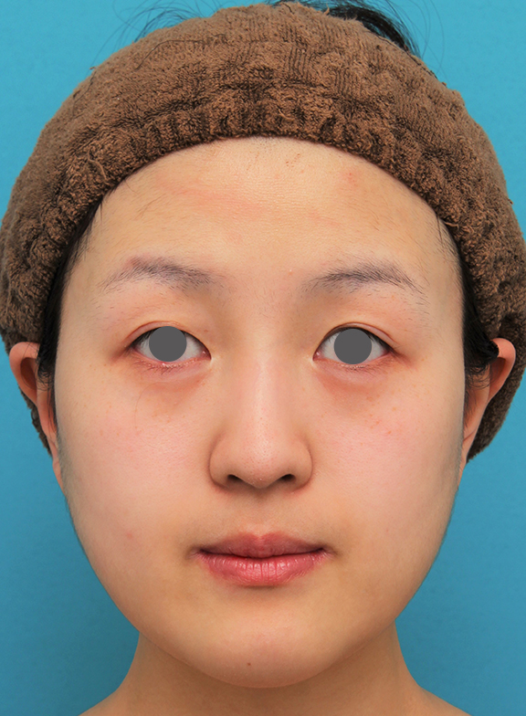 バッカルファット除去,バッカルファット除去手術を行った20代女性の症例写真,After（6ヶ月後）,ba_buccalfat021_b01.jpg