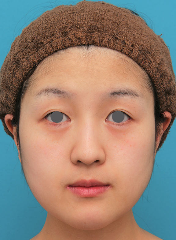 バッカルファット除去手術を行った20代女性の症例写真,Before,ba_buccalfat021_b01.jpg