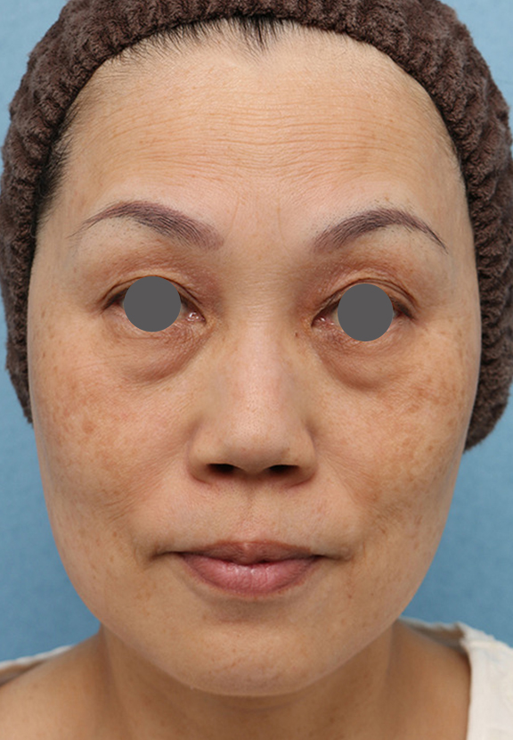目の下のクマ治療,注射式シワ取り 長期持続型ヒアルロン酸注入,目の下の膨らみの段差改善の症例写真,Before,ba_tarumi_under002_b01.jpg