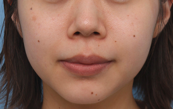 症例写真,ウルセラシステムの症例 頬の肉づき、たるみが気になる30代女性,Before,ba_ulthera035_b01.jpg