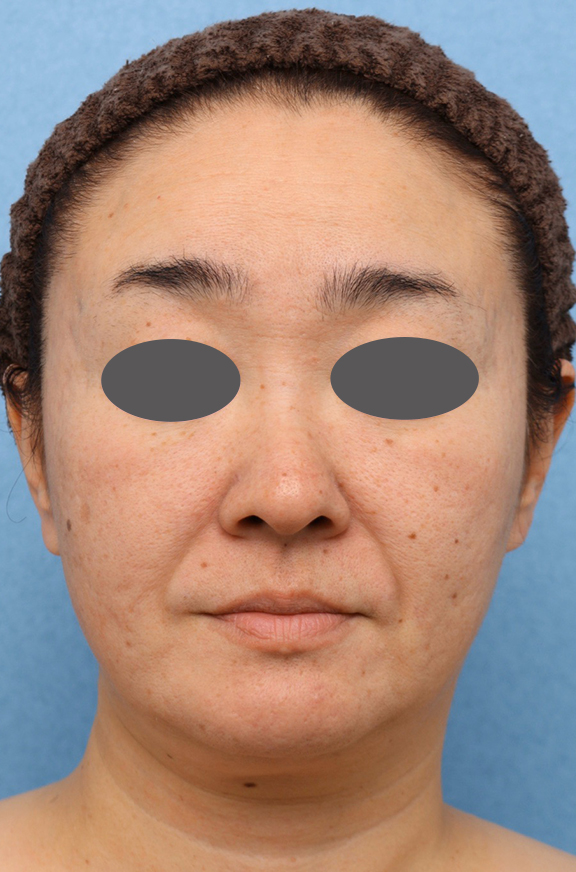 両頬Vシェイプリフト（ヒアルロン酸注射）&amp;アゴ裏イタリアンリフトの症例写真,After（1ヶ月後）,ba_v_shapelift019_a01.jpg