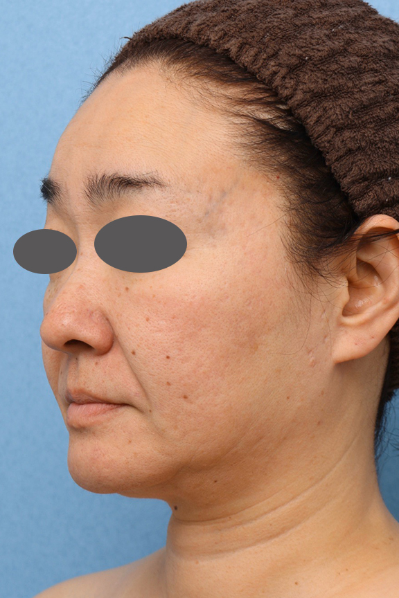 症例写真,両頬Vシェイプリフト（ヒアルロン酸注射）&アゴ裏イタリアンリフトの症例写真,After（1ヶ月後）,ba_v_shapelift020_b02.jpg