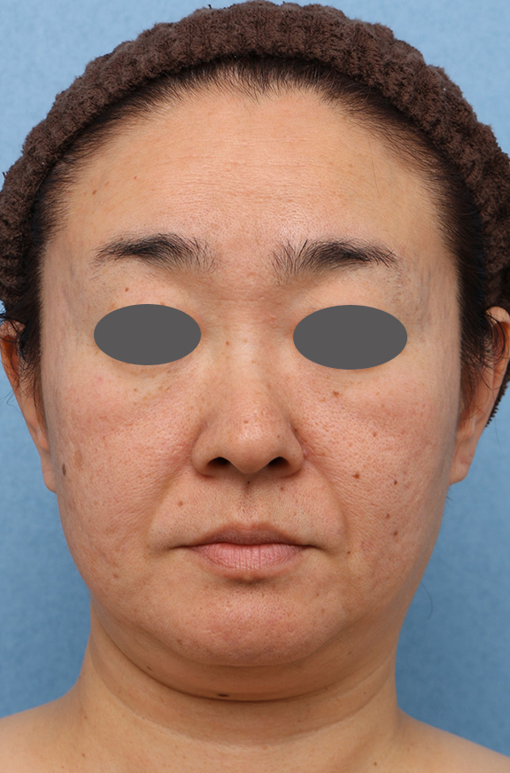 症例写真,両頬Vシェイプリフト（ヒアルロン酸注射）&アゴ裏イタリアンリフトの症例写真,Before,ba_v_shapelift020_b01.jpg