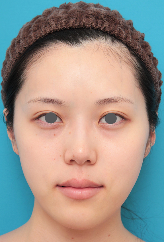 症例写真,チークヒアルと顎のヒアルロン酸注射を同時に行った20代女性の症例写真,After（1ヶ月後）,ba_cheek002_b01.jpg