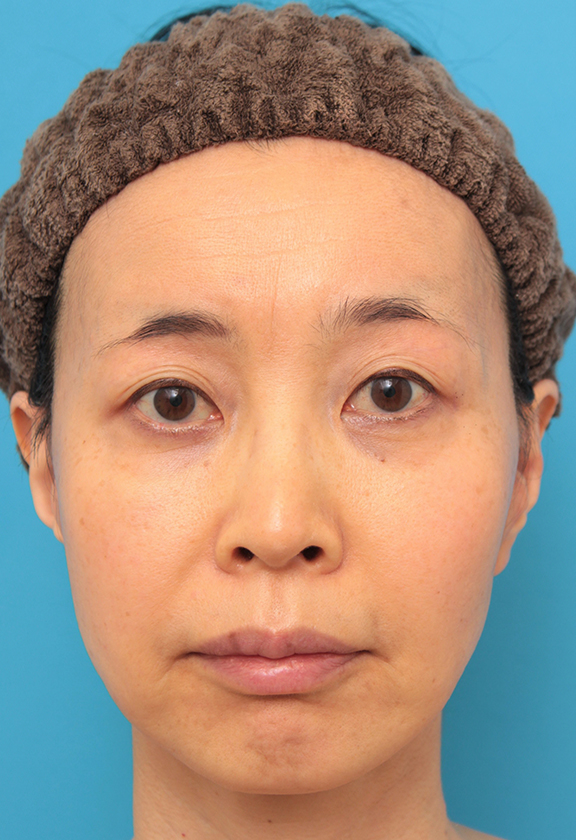 ミディアムフェイスリフトでたるみのリフトアップをした50代女性の症例写真,After（6ヶ月後）,ba_mediumlift012_a01.jpg