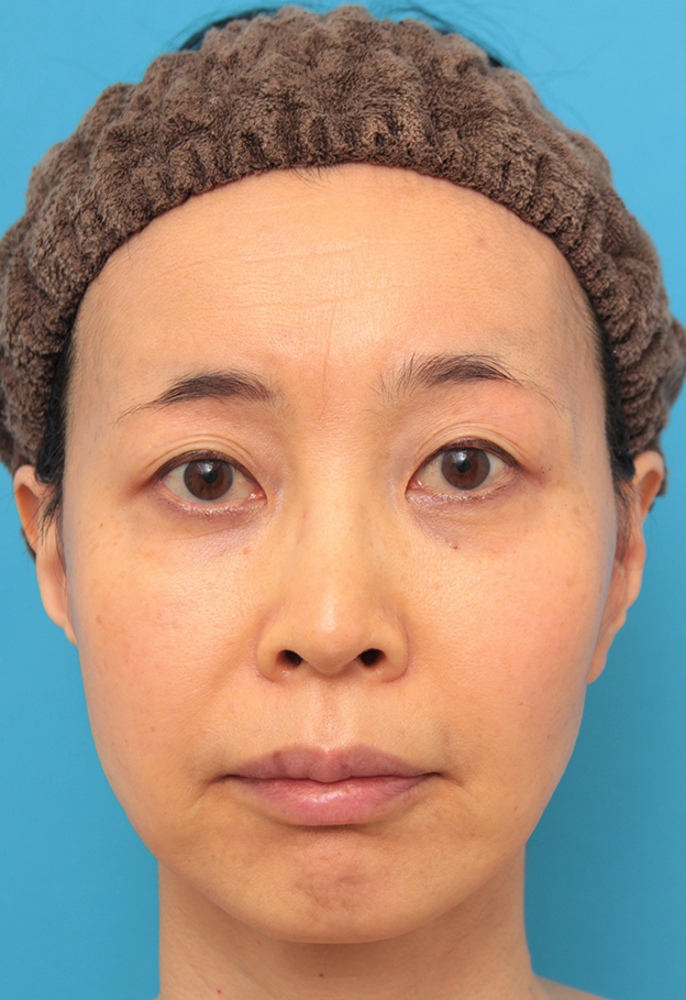 症例写真,ミディアムフェイスリフトでたるみのリフトアップをした50代女性の症例写真,6ヶ月後,mainpic_mediumlift012d.jpg
