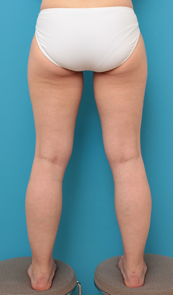 症例写真,太もも全体とふくらはぎの脂肪吸引をした40代女性の症例写真,Before,ba_shibokyuin043_b02.jpg