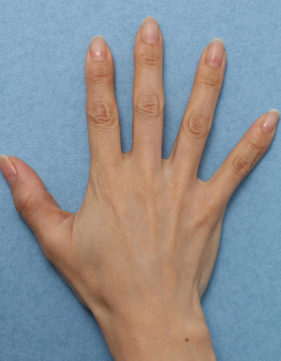手のヒアルロン酸注射の症例写真,Before,ba_hyaluronic036_b01.jpg
