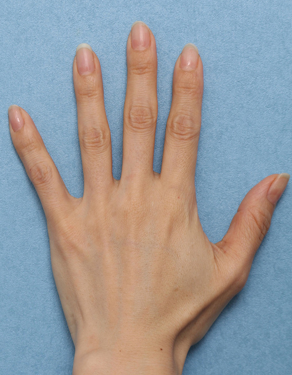 症例写真,手のヒアルロン酸注射の症例写真,Before,ba_hyaluronic036_b02.jpg