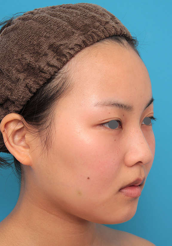 症例写真,顔専用脂肪溶解注射メソシェイプフェイスで小顔になった20代女性の症例写真,After（2回目注射後3週間）,ba_meso_face017_b02.jpg