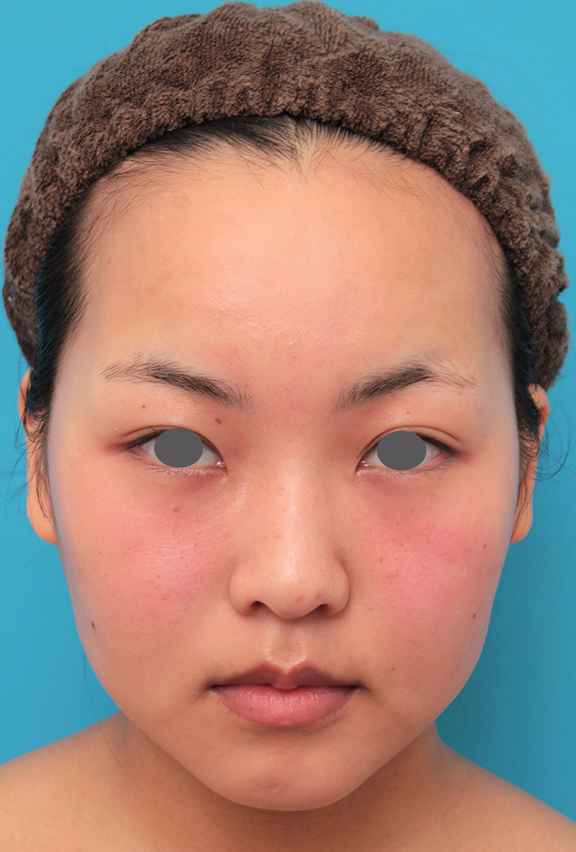 小顔専用脂肪溶解注射メソシェイプフェイス,顔専用脂肪溶解注射メソシェイプフェイスで小顔になった20代女性の症例写真,Before,ba_meso_face017_b01.jpg