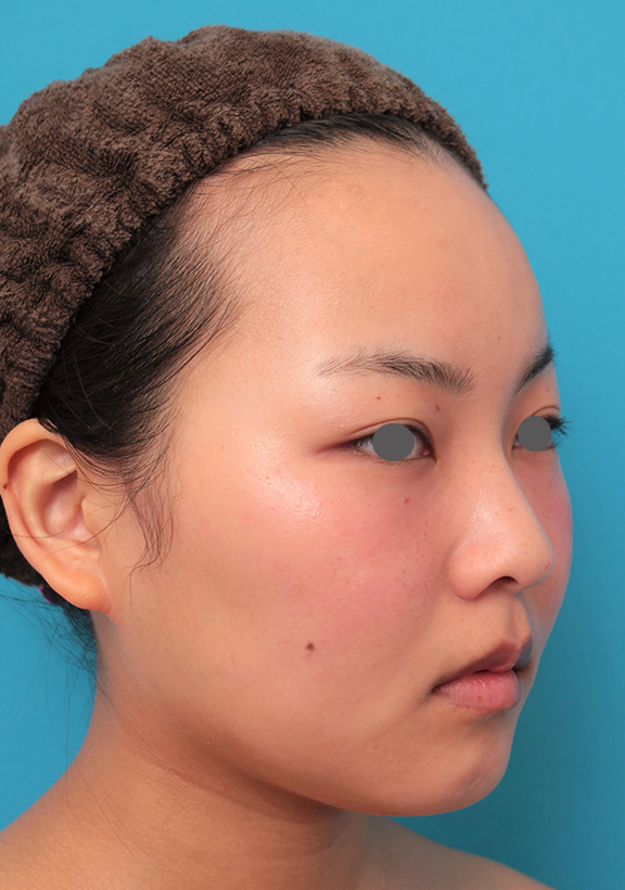 症例写真,顔専用脂肪溶解注射メソシェイプフェイスで小顔になった20代女性の症例写真,Before,ba_meso_face017_b02.jpg