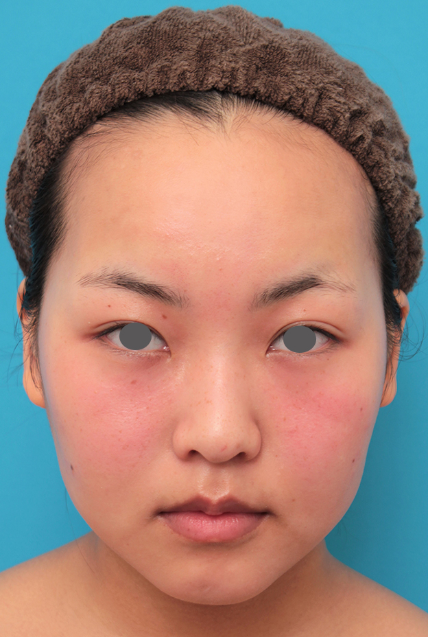 症例写真,顔専用脂肪溶解注射メソシェイプフェイスで小顔になった20代女性の症例写真,治療前,mainpic_meso_face017a.jpg
