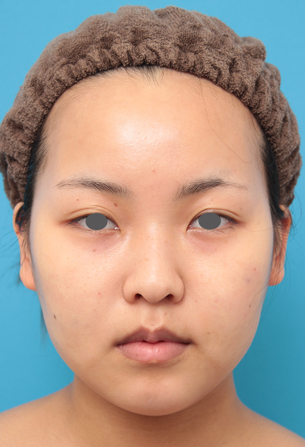 症例写真,顔専用脂肪溶解注射メソシェイプフェイスで小顔になった20代女性の症例写真,1回目注射直後,mainpic_meso_face017b.jpg
