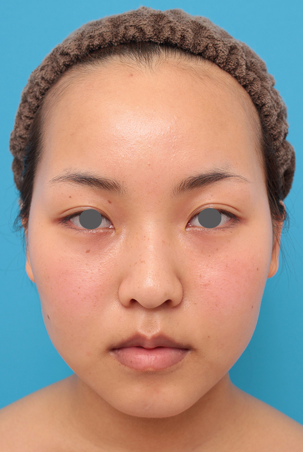 症例写真,顔専用脂肪溶解注射メソシェイプフェイスで小顔になった20代女性の症例写真,1回目注射後3週間,mainpic_meso_face017c.jpg