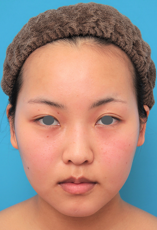 症例写真,顔専用脂肪溶解注射メソシェイプフェイスで小顔になった20代女性の症例写真,2回目注射後3週間,mainpic_meso_face017d.jpg