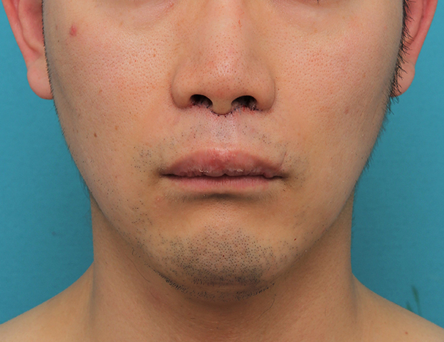 症例写真,リップリフト(人中短縮手術)を行った30代男性の症例写真,手術直後,mainpic_hanashita004b.jpg