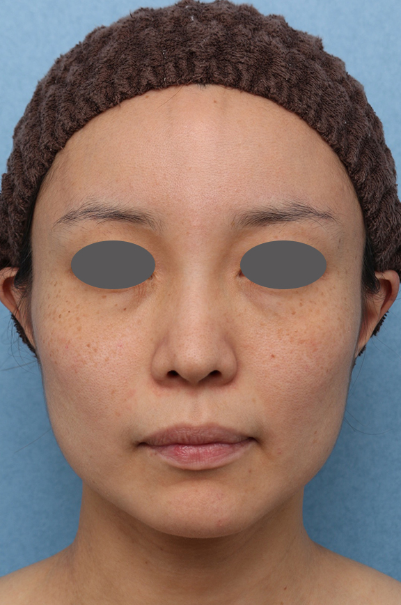 症例写真,ウルセラシステム/ボツリヌストキシン注射の症例 たるみが気になる40代女性,Before,ba_ulthera036_b01.jpg