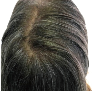 症例写真,ヘアラインで白髪と薄毛を治療した症例写真,After(治療期間1年),ba_hairline001_b01.jpg