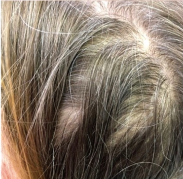 症例写真,ヘアラインで白髪と薄毛を治療した症例写真,Before,ba_hairline001_b01.jpg