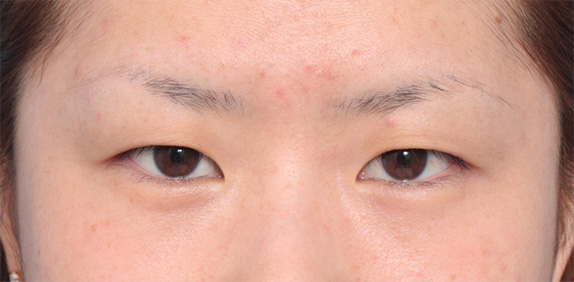 埋没法で平行型二重を作った症例写真,Before,ba_maibotsu38_b.jpg