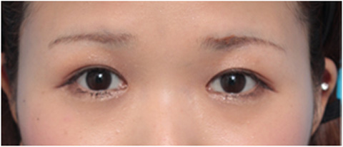 症例写真,埋没法で6mmの末広型ナチュラル二重にした症例写真,１ヶ月後,メイクあり,mainpic_maibotsu08d.jpg
