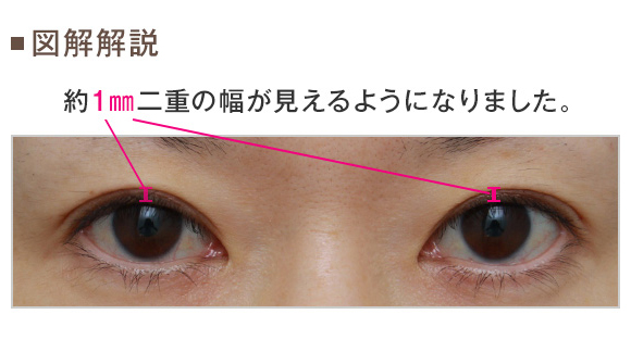 奥二重に対して埋没法を行い わずかに幅を広げた症例写真 美容整形の高須クリニック 東京赤坂 横浜 名古屋 大阪