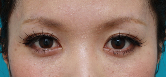 症例写真,目の左右差を両目の埋没法で修正した症例写真,After（メイクあり）<br/>
（1ヶ月後）,