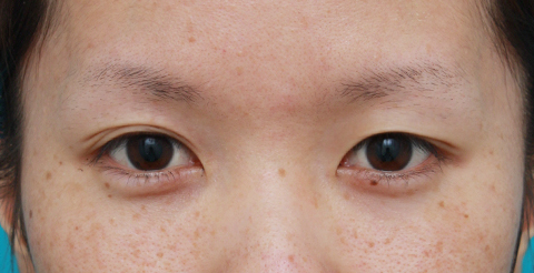 症例写真,目の左右差を両目の埋没法で修正した症例写真,施術前,mainpic_maibotuhou14a.jpg