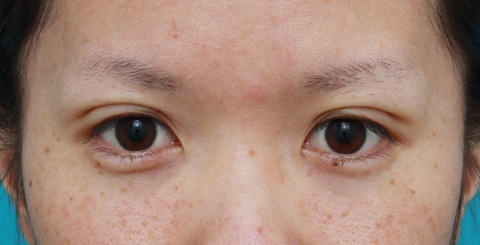 症例写真,目の左右差を両目の埋没法で修正した症例写真,施術直後,mainpic_maibotuhou14b.jpg