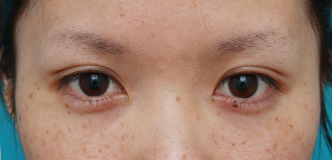 症例写真,目の左右差を両目の埋没法で修正した症例写真,1週間後,mainpic_maibotuhou14c.jpg