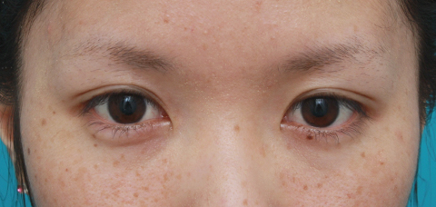症例写真,目の左右差を両目の埋没法で修正した症例写真,1ヶ月後,メイクなし,mainpic_maibotuhou14d.jpg