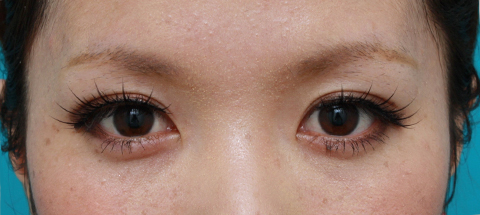 症例写真,目の左右差を両目の埋没法で修正した症例写真,1ヶ月後,メイクあり,mainpic_maibotuhou14e.jpg