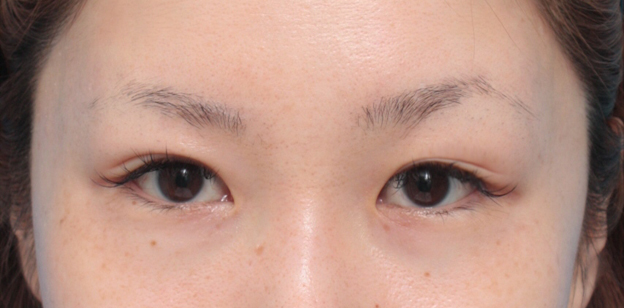 症例写真,狭い末広型二重を埋没法で末広型のまま幅を広げた症例写真,1ヶ月後,メイクなし,mainpic_maibotsu14g.jpg
