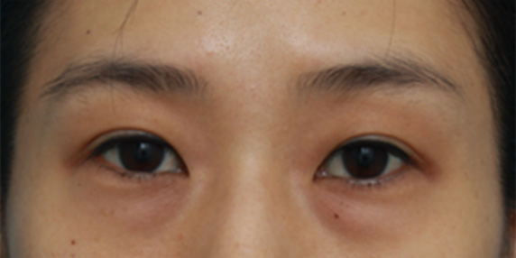 片目の埋没法を行い、左右対称の二重まぶたにした症例写真,After（1週間後）,ba_maibotsu35_a01.jpg