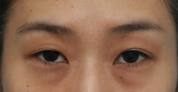 片目の埋没法を行い、左右対称の二重まぶたにした症例写真,Before,ba_maibotsu35_b.jpg