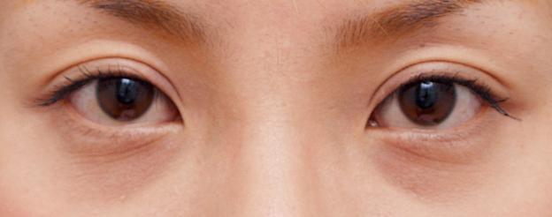 二重まぶた・ミニ切開法（部分切開）の症例写真 くっきりはっきり幅広平行タイプの二重瞼に,After（4週間後）,ba_hoho08_a01.jpg