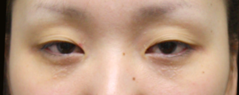 症例写真,二重まぶた・ミニ切開法（部分切開）,手術前,mainpic_mini_sekkai04a.jpg