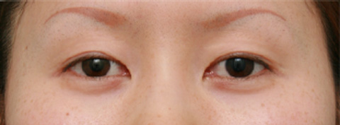 症例写真,二重まぶた・ミニ切開法（部分切開）,手術前,mainpic_mini_sekkai05a.jpg