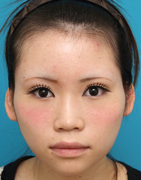 症例写真,二重まぶた・ミニ切開法（部分切開）の症例　目頭切開、垂れ目形成、ボツリヌストキシン注射（エラ、プチ小顔術）も施行,After（メイクあり）,