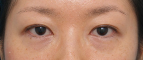 二重まぶた・ミニ切開法（部分切開）の症例 一重で眠そうな目だった女性,After,ba_minisekkai14_a01.jpg