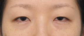 二重まぶた・ミニ切開法（部分切開）の症例 一重で眠そうな目だった女性,Before,ba_minisekkai14_b.jpg