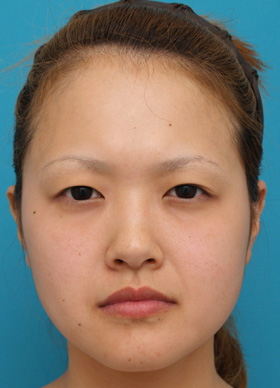 症例写真,ミニ切開二重、鼻ヒアルロン酸、ボツリヌストキシン注射（エラ、プチ小顔術）の症例　モニター写真,Before,ba_minisekkai16_b.jpg