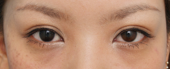 二重まぶた・ミニ切開法（部分切開）の症例 幅の広い平行タイプの二重瞼をご希望の女性,After,ba_minisekkai07_a01.jpg