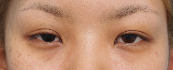 症例写真,二重まぶた・ミニ切開法（部分切開）の症例 幅の広い平行タイプの二重瞼をご希望の女性,Before,ba_minisekkai07_b.jpg